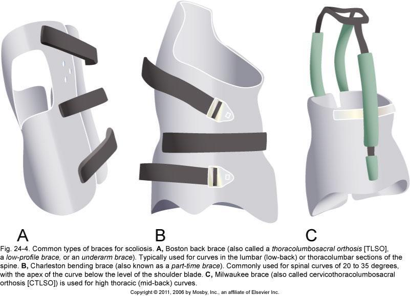 Figure 24-4 Common types of braces for scoliosis. A, Boston back brace (also called a thoraco-lumbrosacral-orthosis [TLSO], a low-profile brace, or an underarm brace).