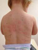 FOOD ALLERGY TESTING Limited food testing if: Persistent eczema despite adequate management Reliable history of immediate allergic reaction after ingestion of offending food Testing to foods has low