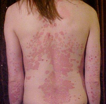 Figure 01: Psoriasis Different Forms of Psoriasis Guttate Psoriasis This usually occurs in adolescents within few weeks after a hemolytic streptococcal infection. The lesions disappear spontaneously.