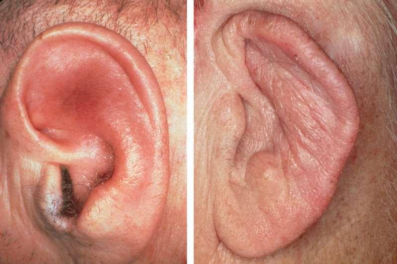 Q. Category 5 - $500 A. Left: Early relapsing polychondritis- redness and swelling of the auricle. B.