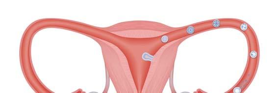 The normal fertilisation process In a normal menstrual cycle of approximately 28 days ovulation takes place around day 14.