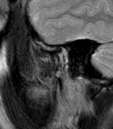 Weighted MRI of left TMJ in closed mouth