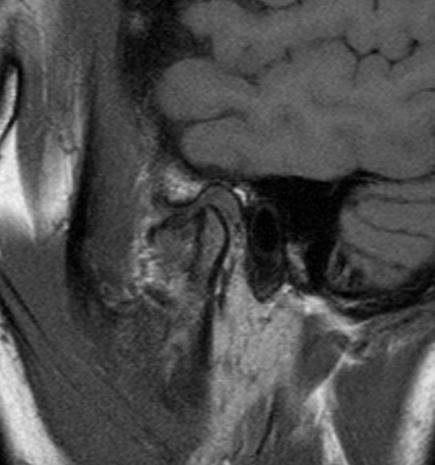 Sagittal T1 Weighted MRI in open mouth position