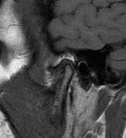 Post-Treatment MRI Sagittal Sections Fig.