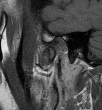 5: Post-Treatment Sagittal T1 Weighted MRI in