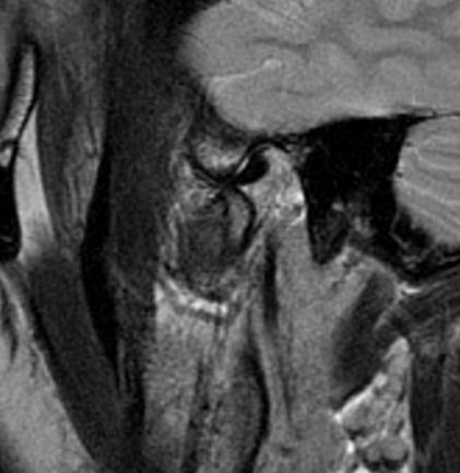 6: Post-Treatment Sagittal T2 Weighted MRI in 