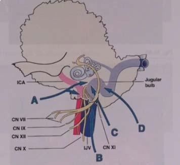 Abordul pentru meningioamele de jugular foramen Meningioamele care implică jugular foramen sunt deseori invazive. Pacienţii prezintă paralizii ale nervilor cranieni inferiori.