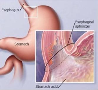 A Hiatus Hernia occurs at the point where the oesophagus passes through the diaphragm, which results in the sphincter muscle at the lower end of the oesophagus not contracting properly and
