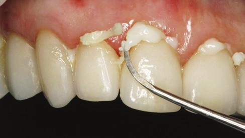 Tack cure of RelyX Veneer Cement. Figure 9. Removal of excess cement. Figure 10. Final clean-up. Figure 11. Completed treatment.