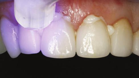 As someone who routinely uses direct composite resin; bonded ceramic veneers with light cure cement; ceramic crowns, both etchable ceramic and