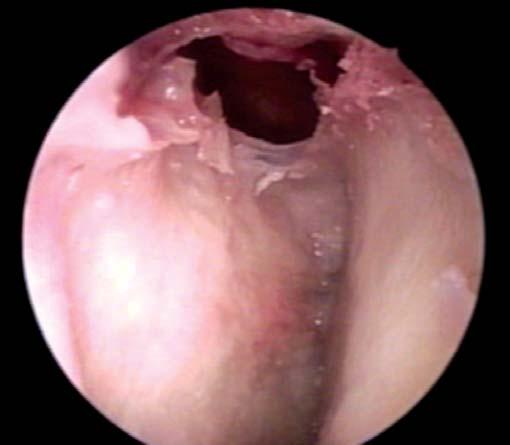 The resection of posterior one-third of superior turbinate is usually done in medial to middle turbinate approach to sphenoid sinus. Supreme turbinate is present in very few cases.