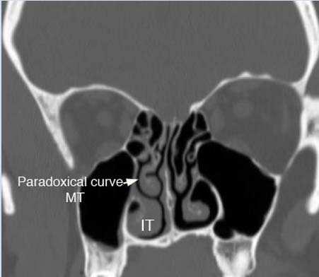 FIG 6: CORONAL CT IMAGE SHOWING PARADOXICAL TURN OF RT MIDDLE