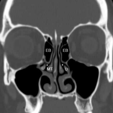 FIG 8: CORONAL CT IMAGE SHOWING BILATERAL LARGE ETHMOIDAL BULLAE (EB) COMPROMISING THE OUTFLOW OF BOTH THE