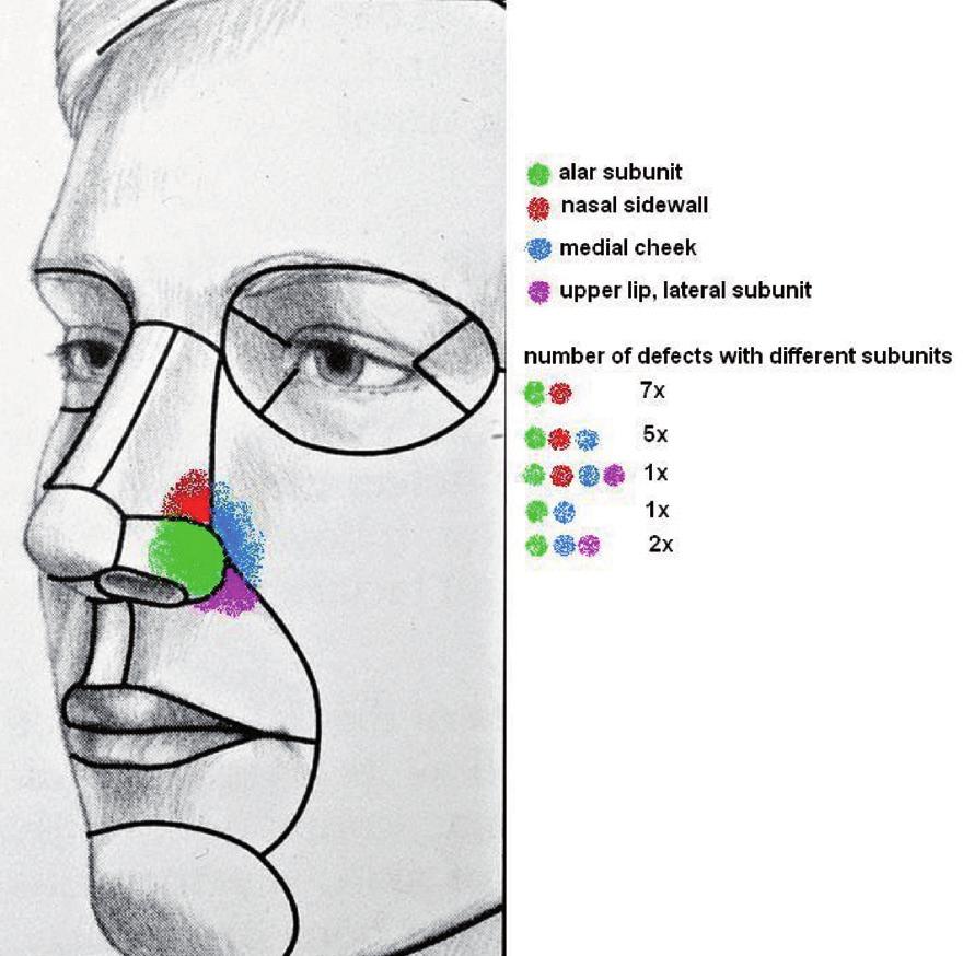 Figure 1. Number of defects involving different nasal and facial subunits undertaken in a modular fashion, addressing each subunit individually.