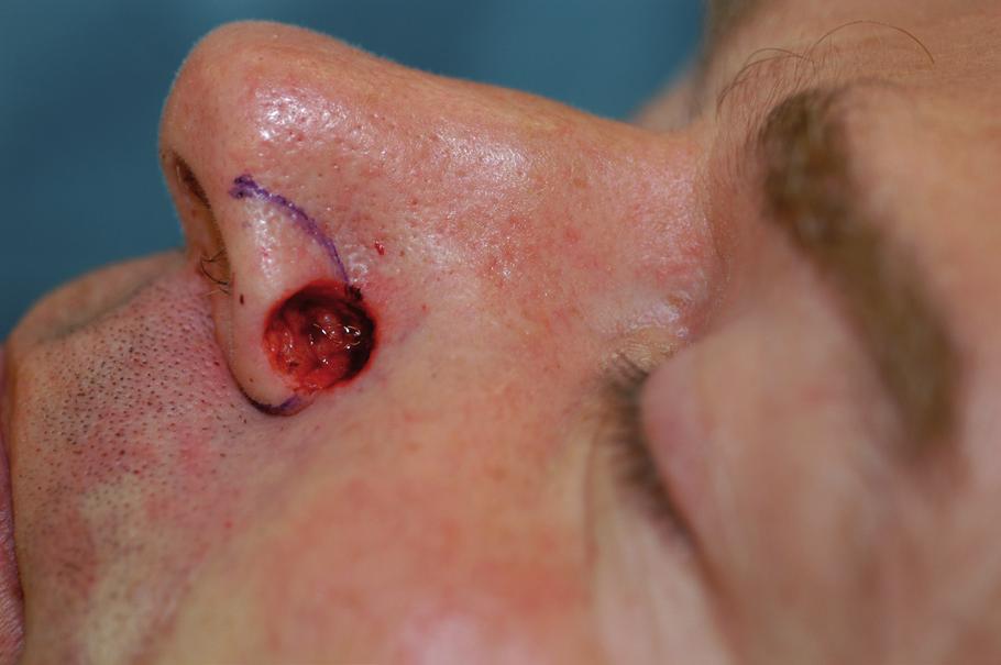 was repaired with a cheek advancement flap, and the exposed fat flap allowed healing by secondary intention. Full epithelialization was seen at four weeks.