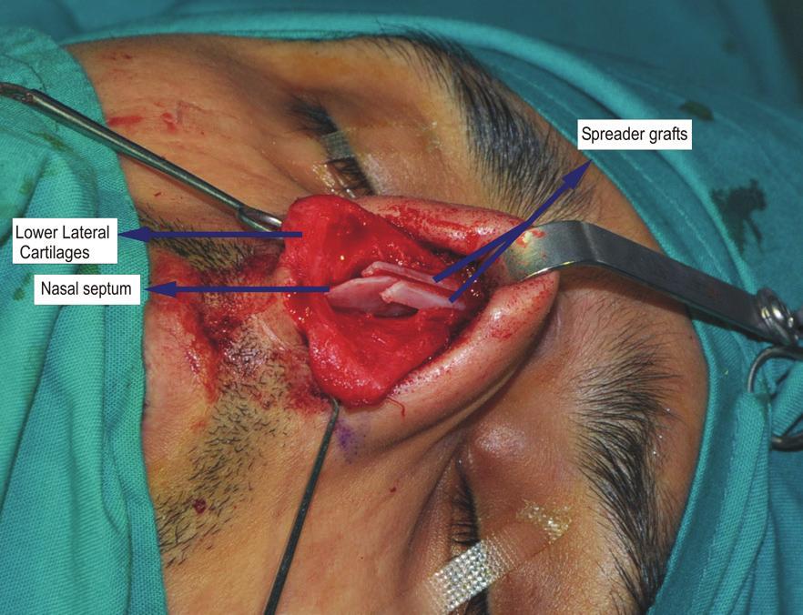 20 Component rhinoplasty were used in 85% of the patients. In 11% of the patients, conchal grafts were used. In no patient, the inferior turbinectomy was performed.