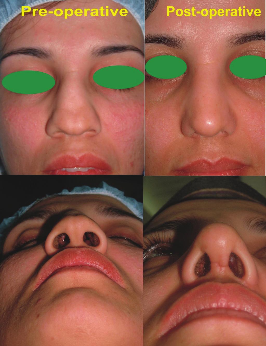 22 Component rhinoplasty Fig. 5: A young female with depressed nasal dorsum. This approach provided the degrees of different resection levels for each component to achieve the best result.