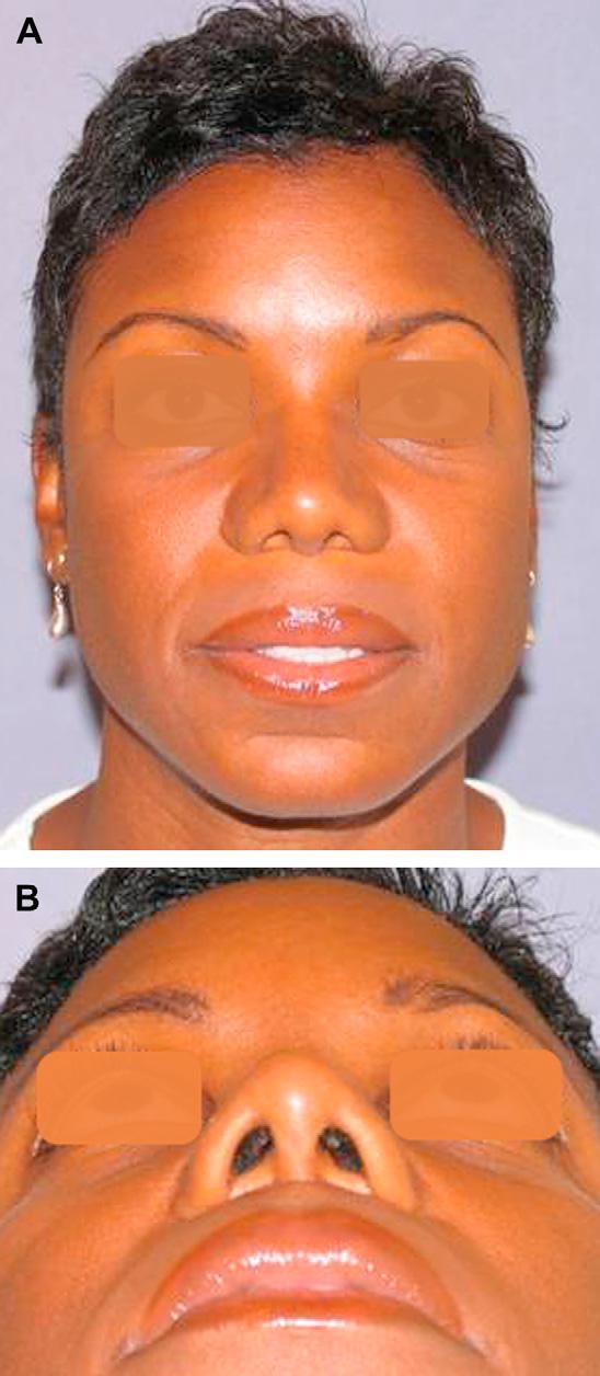 Author's personal copy Rhinoplasty in the Patient of African Descent 195 The author has found it to be an aesthetically exceptional material, with ease of sculpting, excellent blending with the