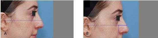 CenoDerm vs Fascia Lata in Rhinoplasty Surgical Procedures After elevating the skin flap and removal of the dorsal hump without modification of the radix, the requirement for correction in each