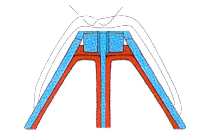 Flaring Sutures Placement varies Can be used