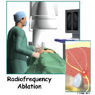 Introduction Radiofrequency ablation is a treatment where radio waves are used to create heat and destroy part of a nerve.