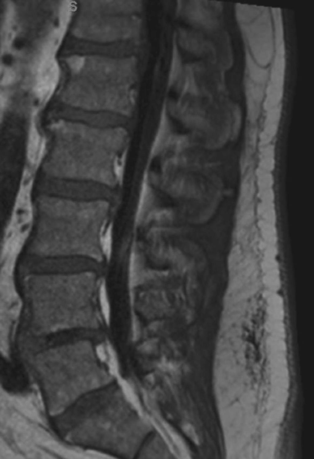Dry Taps Causes Elderly patient Dehydration Spinal stenosis Narrowed IT space Clumping of nerve roots Epidural lipomatosis Narrowed IT space Solutions Re-insert stylet and withdraw again