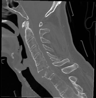 Figure 1: Sagittal CT image of the C6