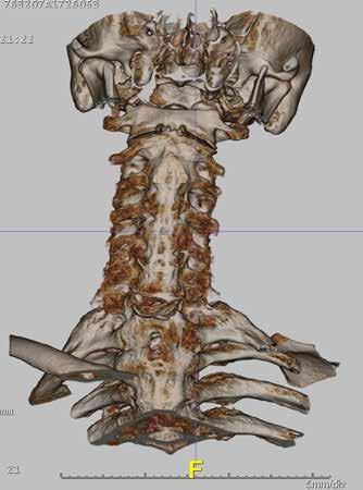 Figure 3: Sagittal 3D CT reconstruction of
