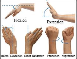 Wrist Movements Wrist Sprains A sprain is the most common injury to the wrist, and in most cases, the most poorly managed injury in sports.