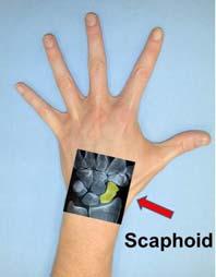 Scaphoid Fracture Is the most frequently fractured bone of the carpal bones.