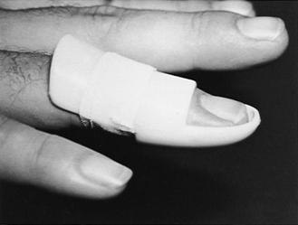 Mallet Finger RICE is given for the pain and swelling. If there is no fracture, the distal phalanx should be immediately splinted in position of extension for a period of 6 to 8 weeks.