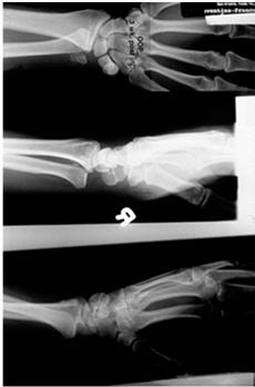 Isolated dislocation of the