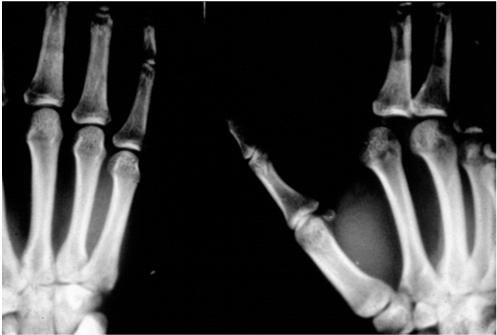 Bennett s fracture dislocation of the thumb A