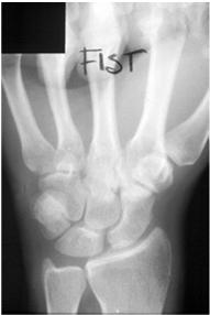 Dislocation of the