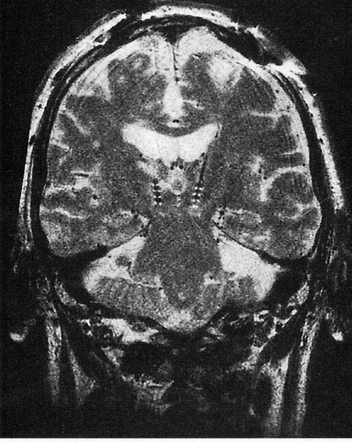 Bilateral Deep-Brain Stimulation of The Globus Pallidus or