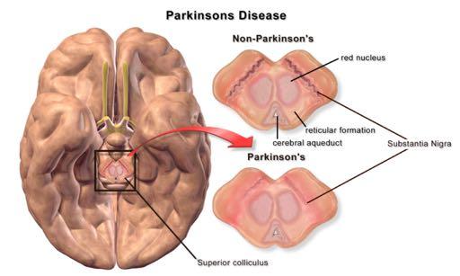 Parkinson s disease Parkinson's disease (PD) is a long-term degenerative disorder of the central nervous system that mainly affects the motor system.