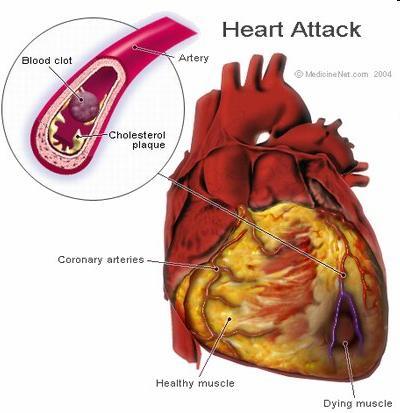 Heart Blockage of the coronary blood