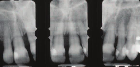 09Strssler:Strssler 8/6/09 9:48 AM Pge 3 ce dentlcetody.com Test 117 3 Tooth Stiliztion Improves Periodontl Prognosis: A Cse Report Howrd E.