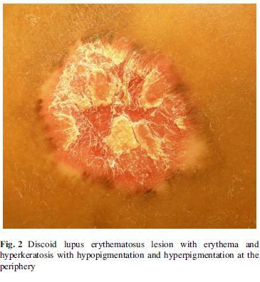 Chronic CLE LE-specific lesions Classic discoid lupus is the most common