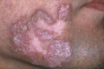 Uncommon forms of chronic CLE: Hyperkeratoitc DLE Thickened lesions on the