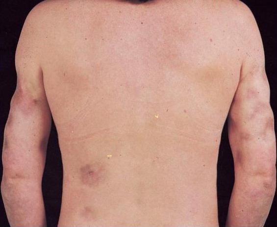 Uncommon forms of chronic CLE: LE Panniculitis Involvement of the deep dermis and underlying adipose tissue Presents as firm, depressed nodules