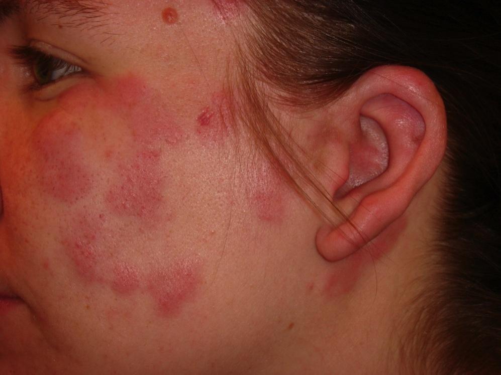 Uncommon forms of chronic CLE: LE Tumidus Deeply erythematous, urticarial plaques with minimal surface change No follicular plugging and rich mucin