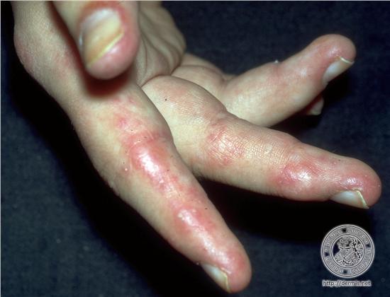 Uncommon forms of chronic CLE: Chilblain LE Violaceous papules and