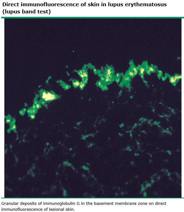 CLE: Lupus Band test Direct immunofluoresnce of skin showing immunoreactant deposition along the DEJ.