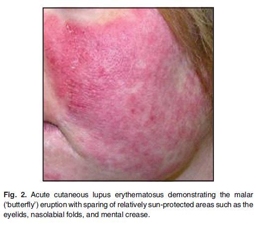 Acute CLE (ACLE) May be localised Butterfly malar rash May mimic acne rosacea Or generalised as a component of SLE I.e. above and below the neck Photosensitive and transient (daysweeks) Bullous lesions may be present Post inflammatory hyper pigmentation can ensue after active phase of eruption.