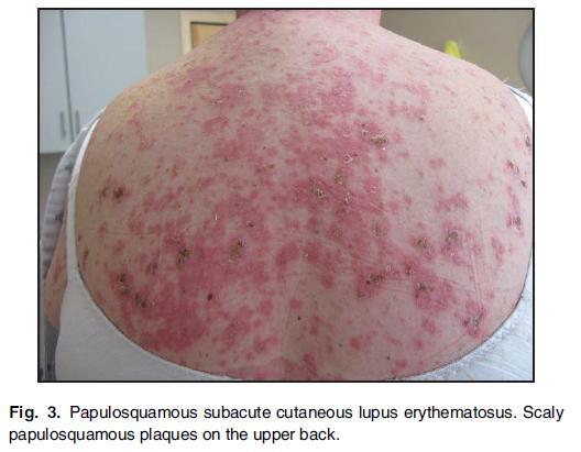 Symmetric erythematous eruptions of non-indurated macules and papules
