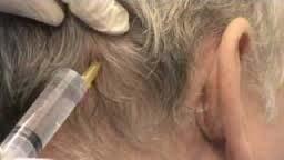 Efficacy Effective for May be useful for Greater Occipital Nerve No evidence for efficacy for
