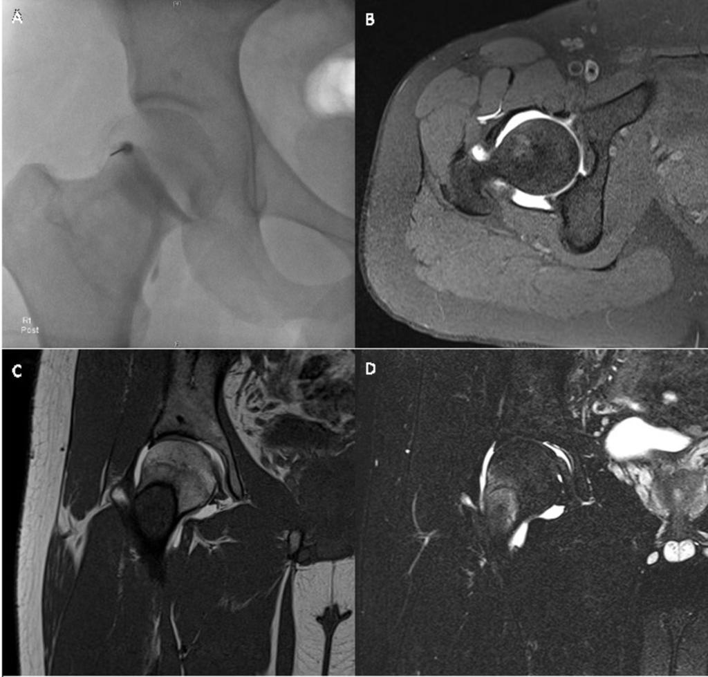 Fig. 1: A) Fluoroscopic image of a left shoulder after fluoroscopic guided intra-articular contrast injection with needle in situ.