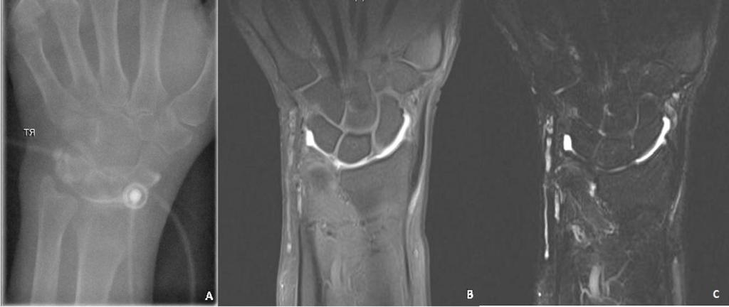Fig. 3: A) Fluoroscopic image of a right wrist after fluoroscopic guided intra-articular contrast injection with needle in situ.