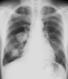 Diagnosis CXR: Round or oval mass with smooth borders. No calcifications.